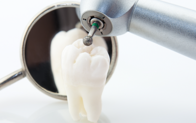 ¿Cuál es el mejor momento para extraer las muelas del juicio?